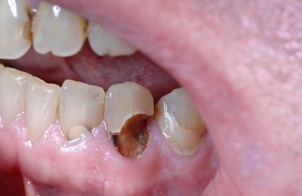 Zähne mit 20 schlechte Welchen Einfluss