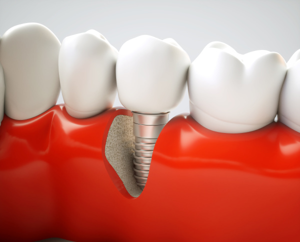 dental implant 3d rendering