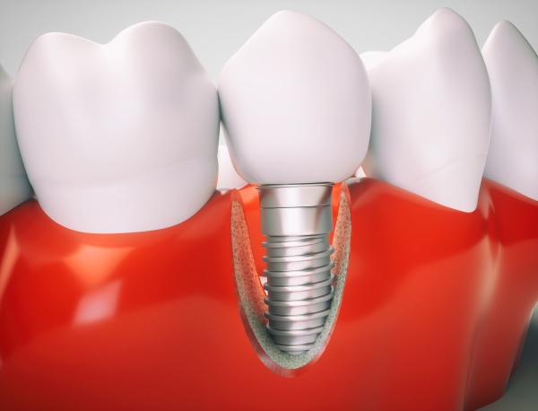 dental implant 3d rendering