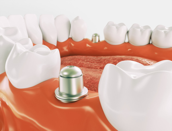 dental implant series 1