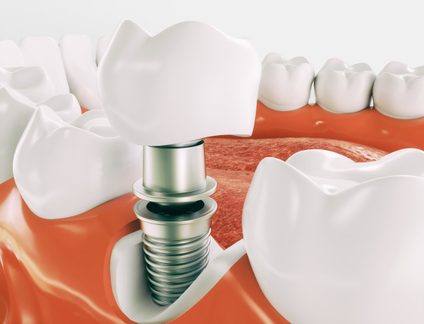 dental implant series 2