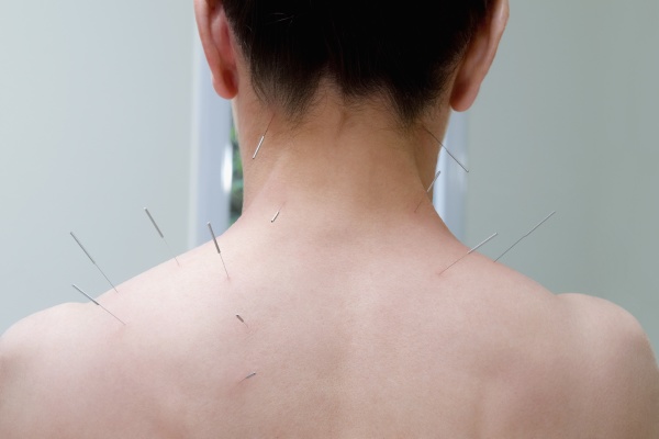 akupunkturnadeln auf dem ruecken einer person
