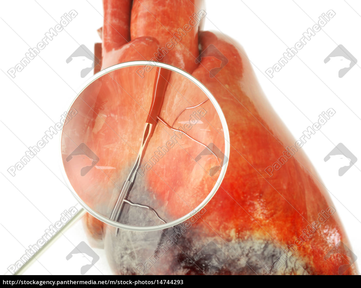 Herzinfarkt Mit Absterbendem Herzmuskelgewebe Lizenzfreies Bild 14744293 Bildagentur Panthermedia